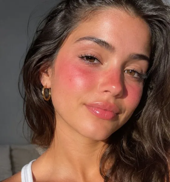 blush sol 1 - Sunburn blush vira febre nas redes sociais: entenda por que imitar a queimadura de sol preocupa quem cuida da pele